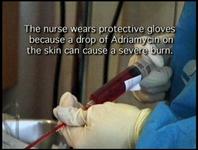 Latex-gloved hands, holding a syringe.  With text: The nurse wears protective gloves because a drop of Adriamycin on the skin can cause a severe burn.